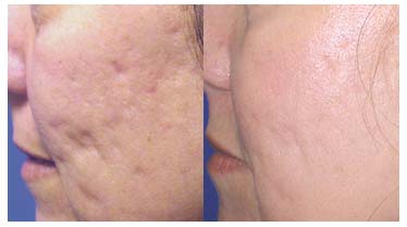 Fraxel Acne Treatment Before & After